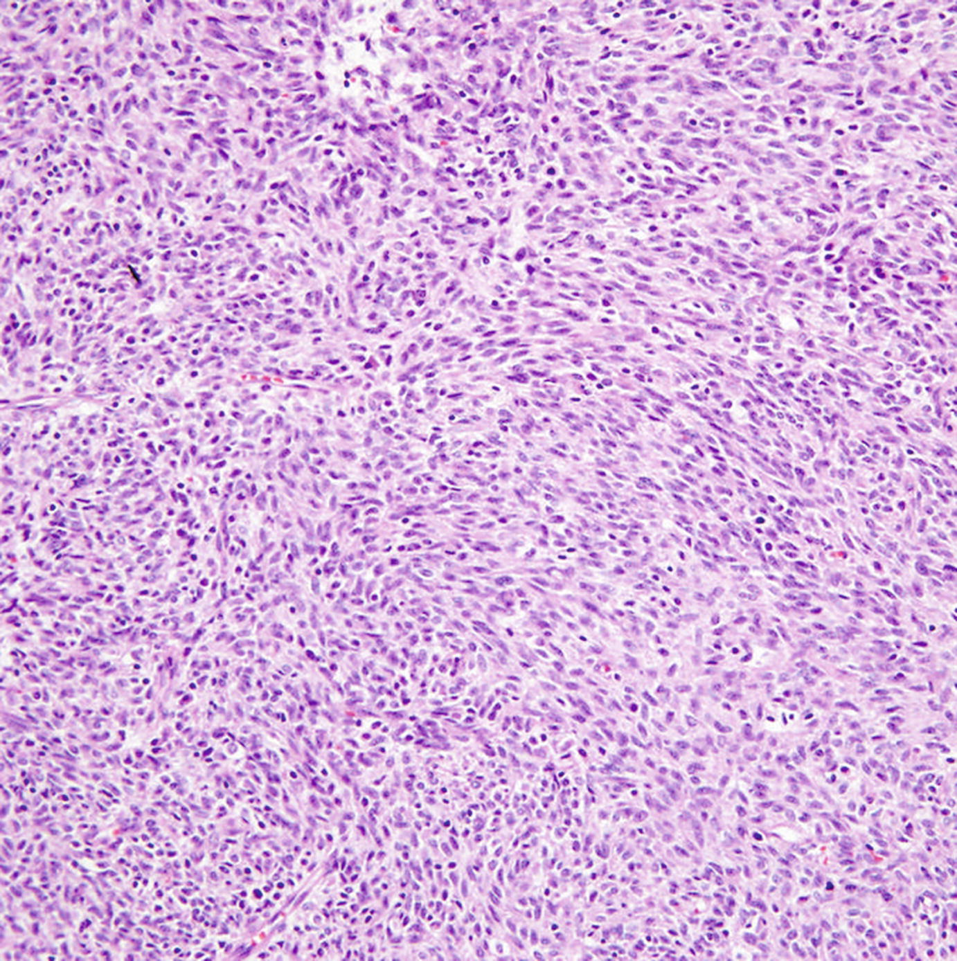 Molecular Pathology Of Pediatric Renal Tumors Springerlink