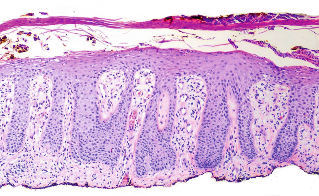 plaque psoriasis histology)