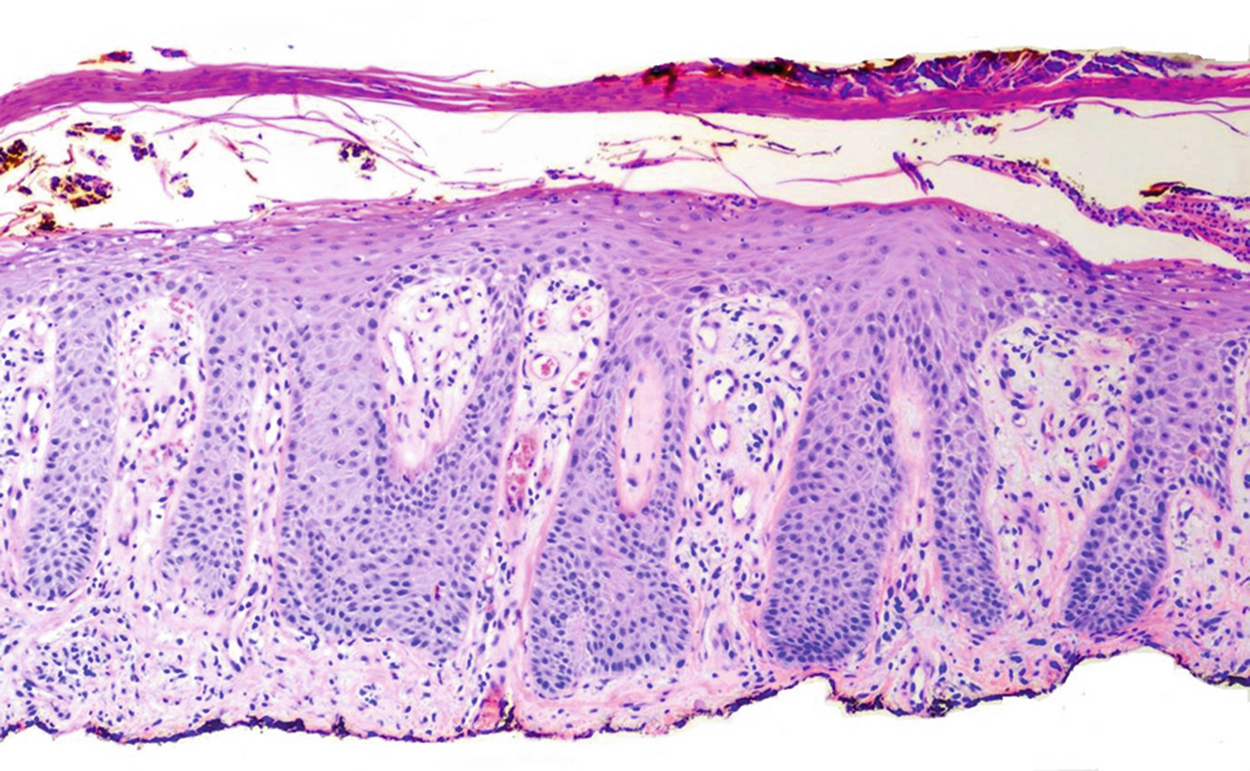 palmoplantar pustular psoriasis pathology