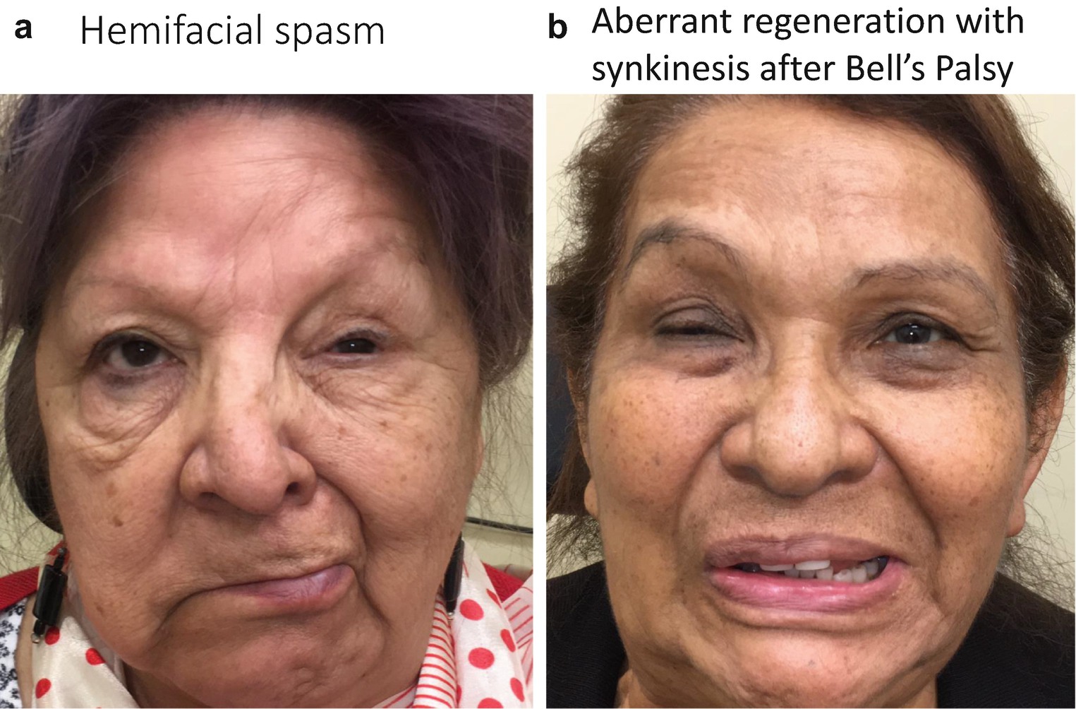 free clinical trials for blepharospasms