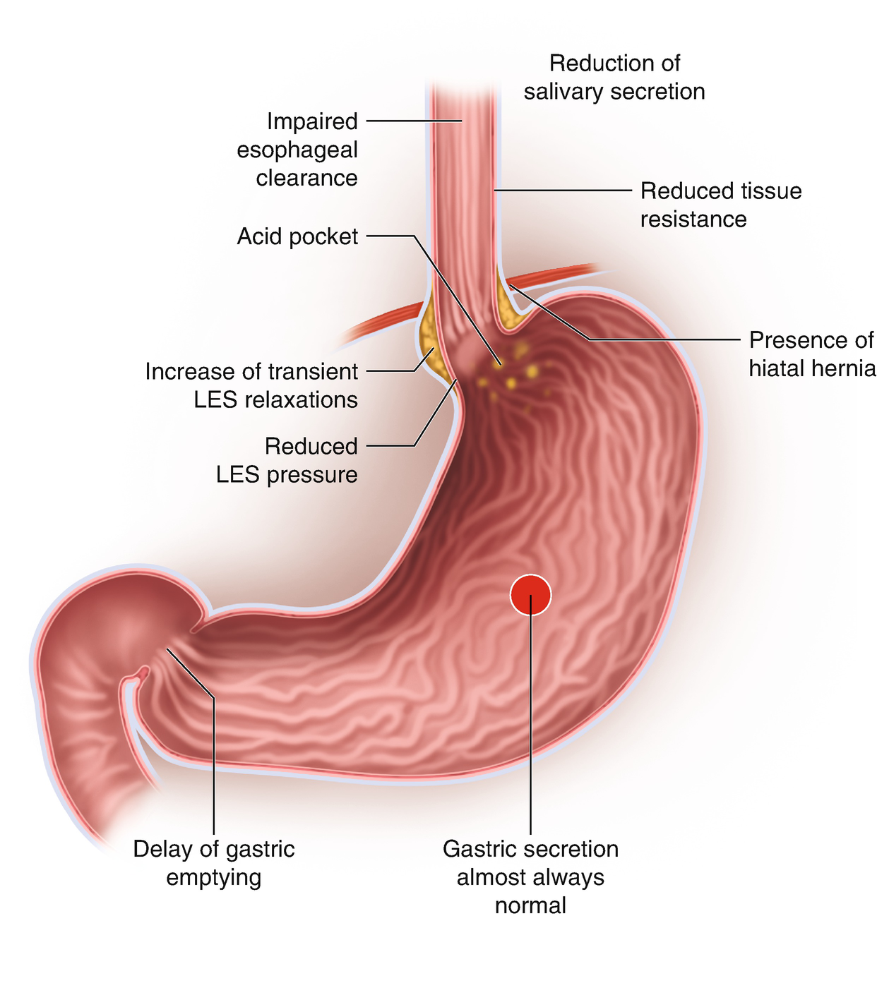 Acid Suppression For Management Of Gastroesophageal Reflux Disease gastroesophageal reflux disease