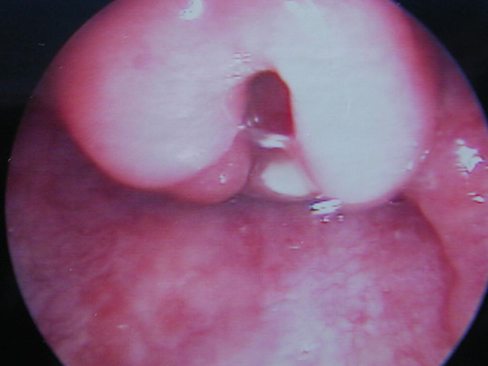 diffúz laryngotrachealis papillomatosis
