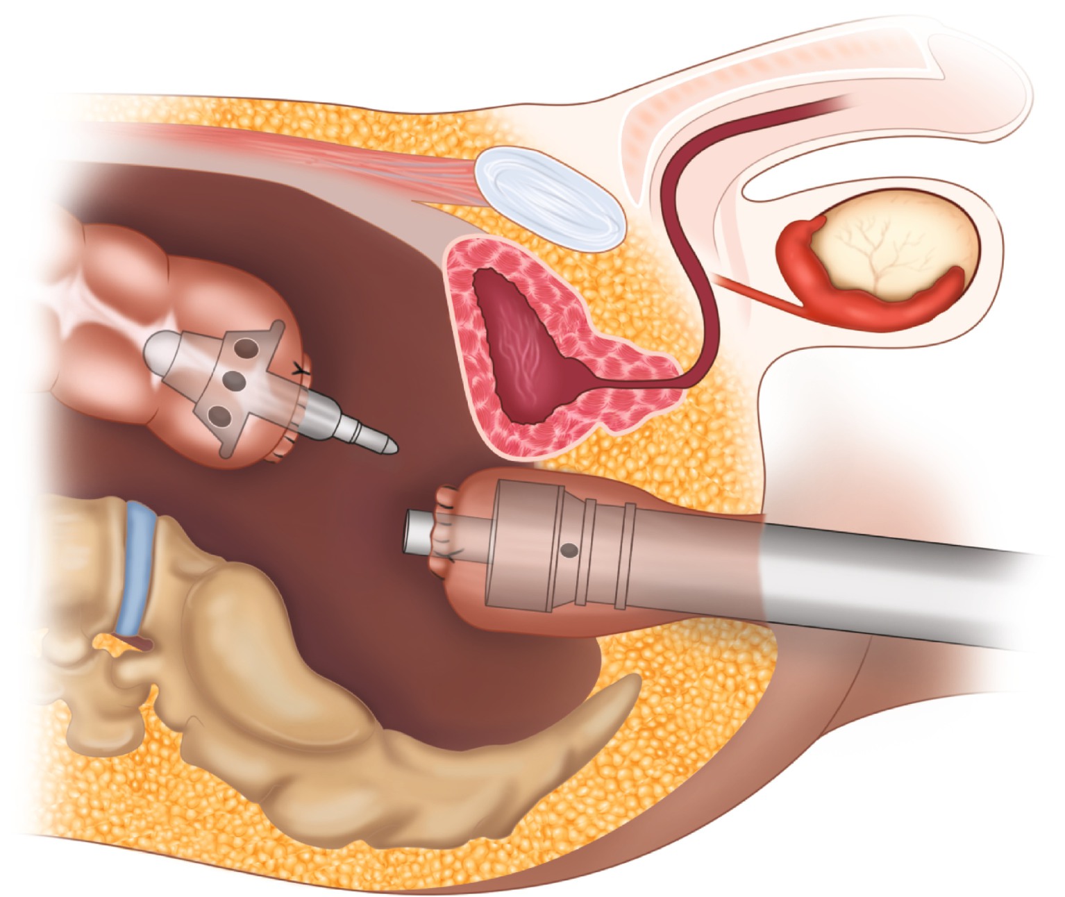 Laparoscopic Low Anterior Rectal Resection With Diverting Loop Ileostomy Springerlink