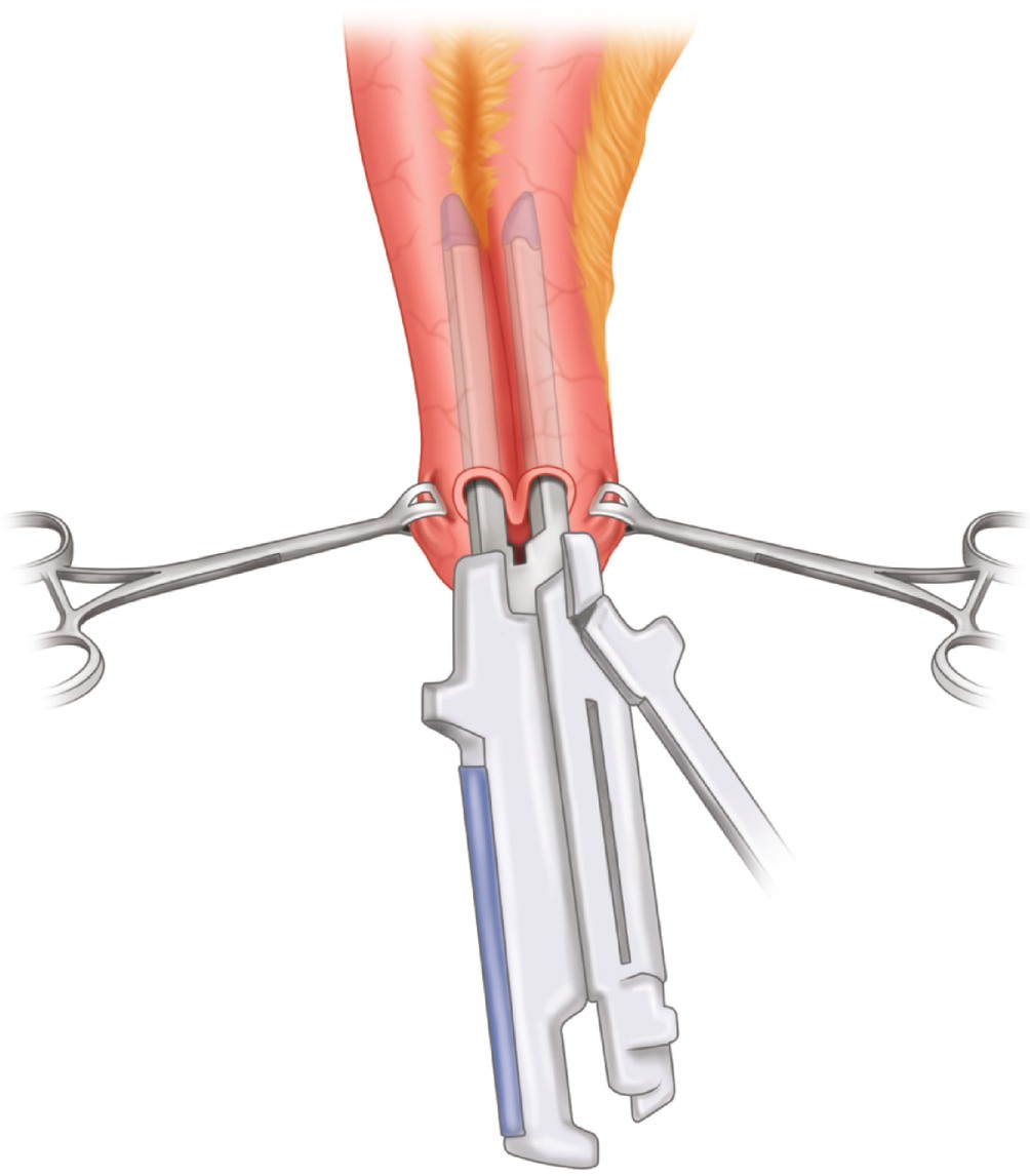 Loop Ileostomy Creation and Closure SpringerLink