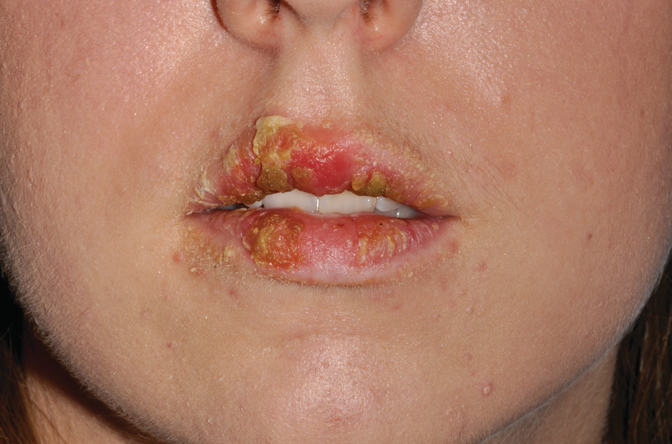Case 2: Diagnostic Dilemma - Crusty Lips | SpringerLink Case 2: Diagnostic Dilemma - Crusty Lips | SpringerLink
