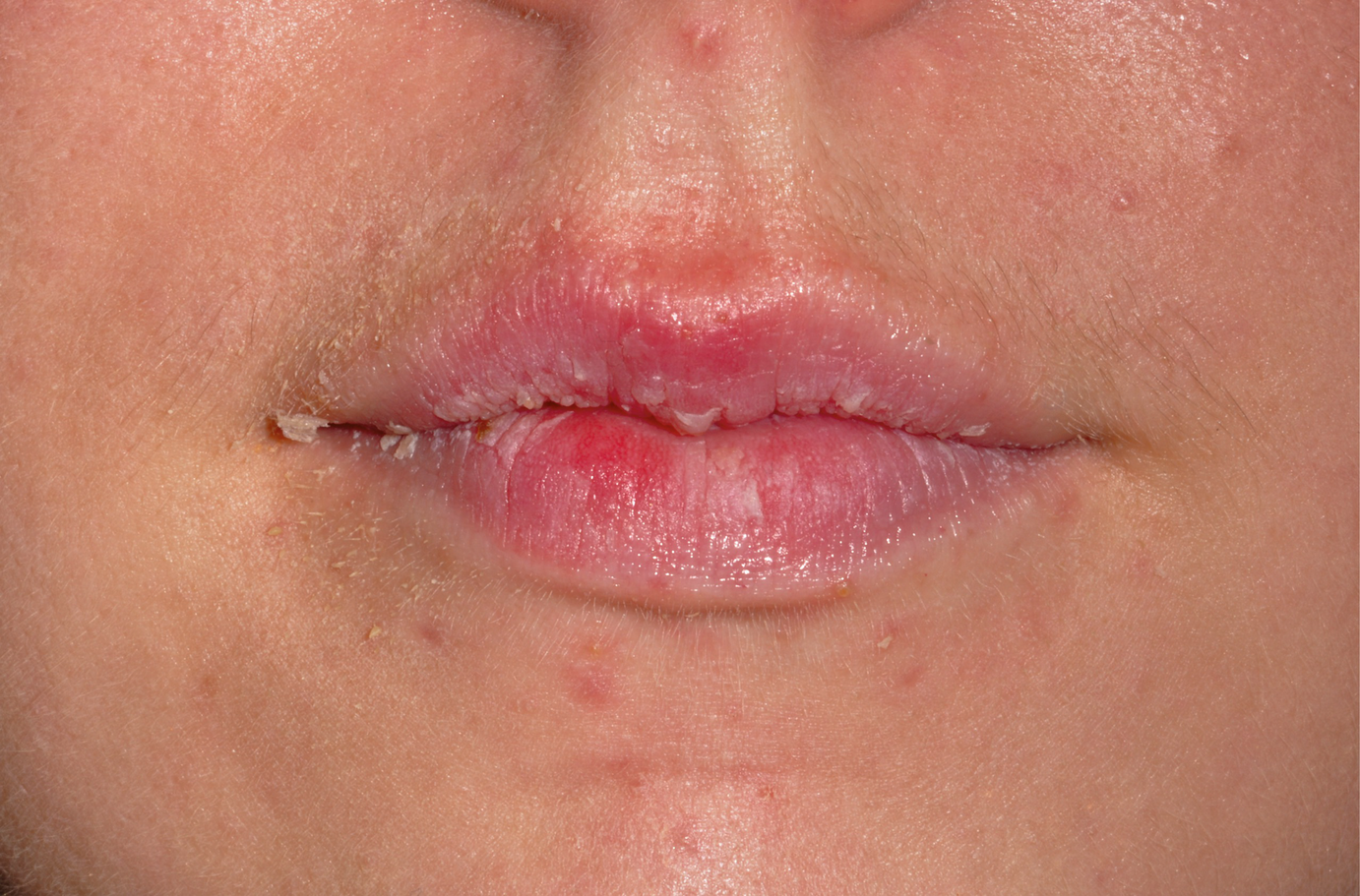 Case 2: Diagnostic Dilemma - Crusty Lips | SpringerLink Case 2: Diagnostic Dilemma - Crusty Lips | SpringerLink
