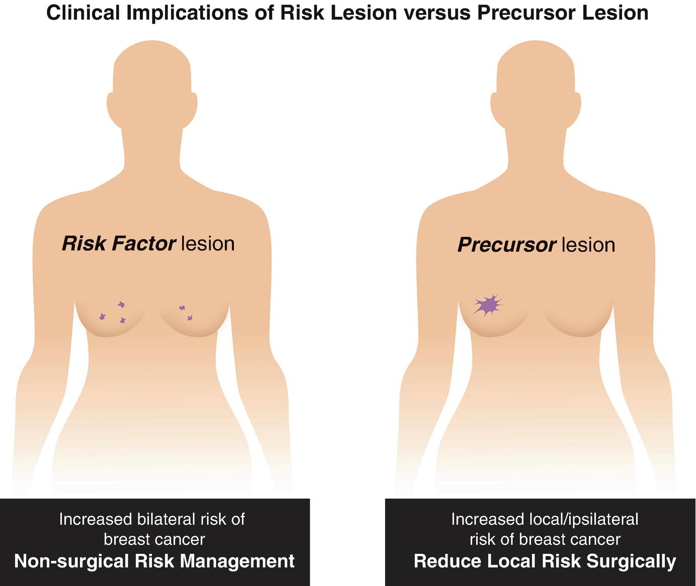 The Spectrum Of Risk Lesions In Breast Pathology Risk Factors Or Cancer Precursors Springerlink