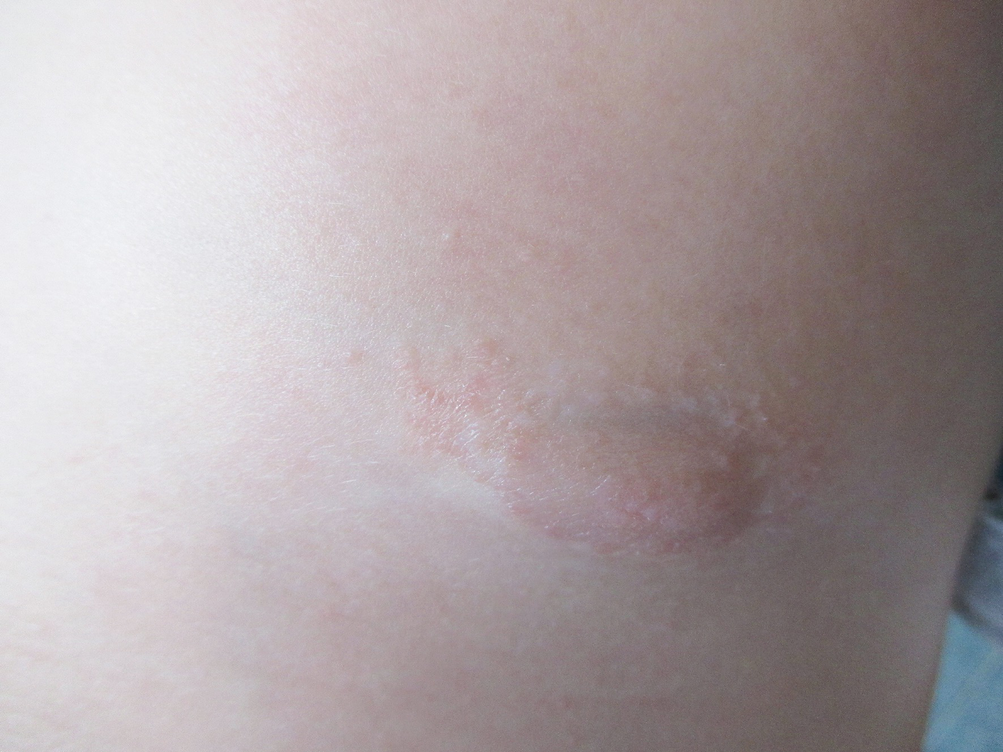 Dermatologic Diseases Of The Breast And Nipple Springerlink