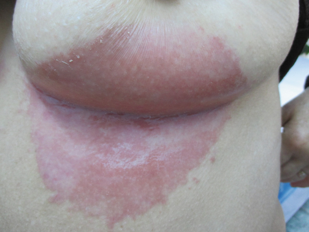 Dermatologic Diseases Of The Breast And Nipple Springerlink