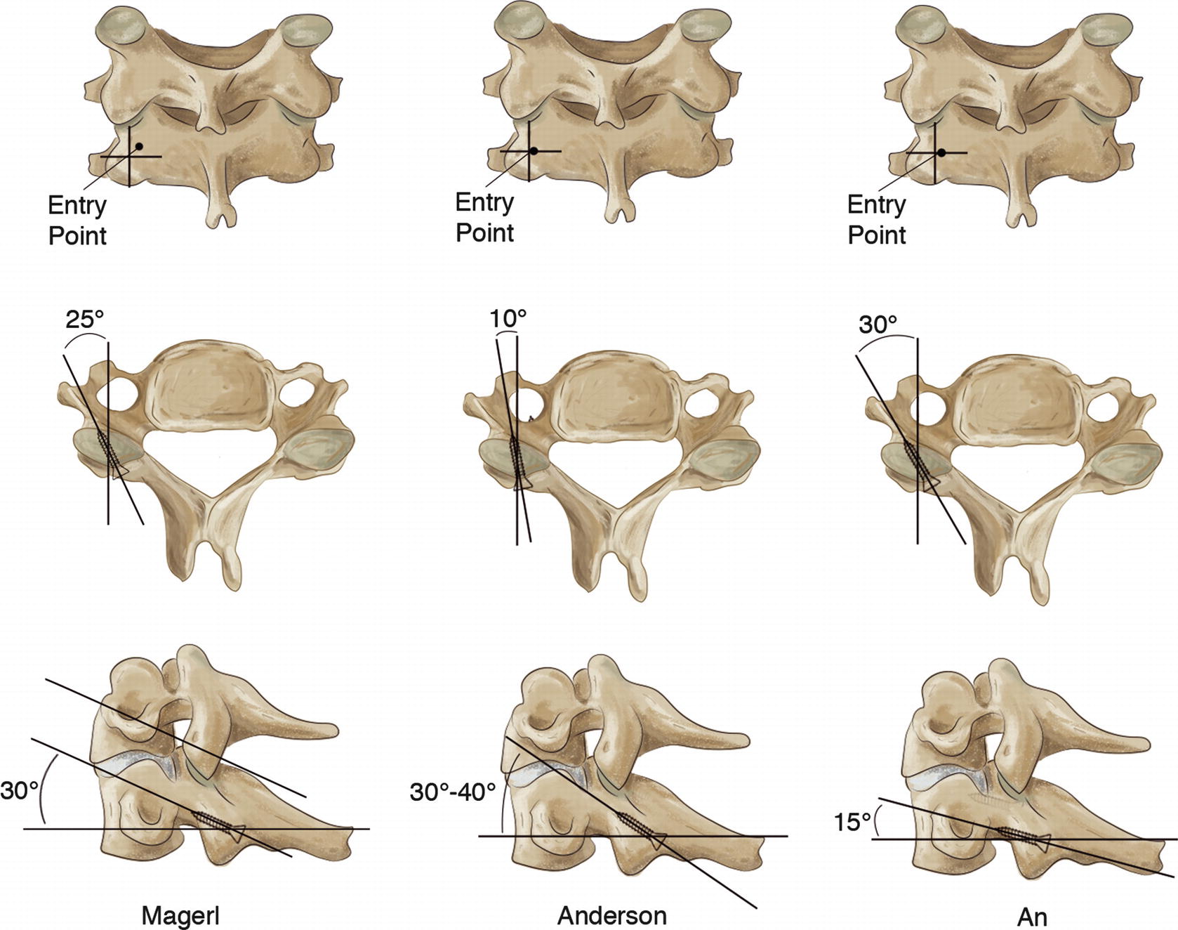 Lateral Mass Screw Fixation SpringerLink