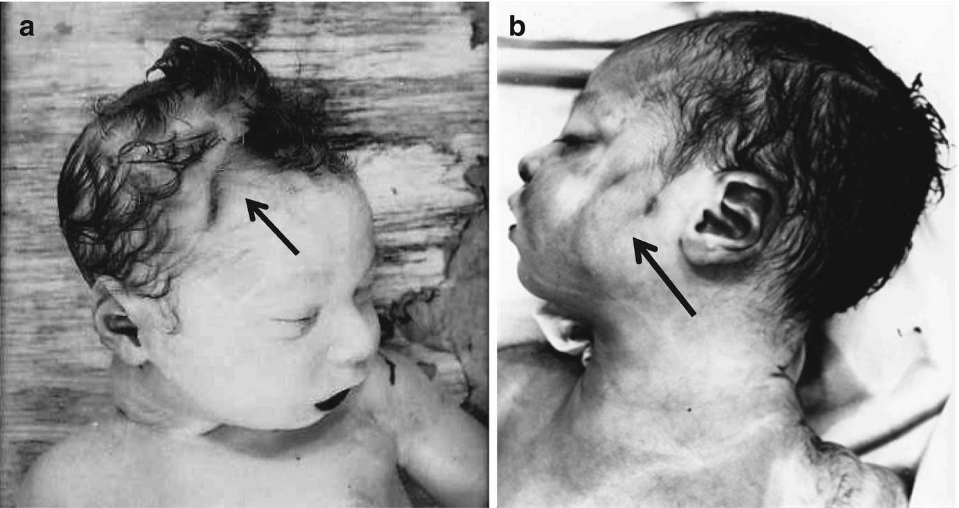 Brain Lesions In Obstetrical Operations Springerlink