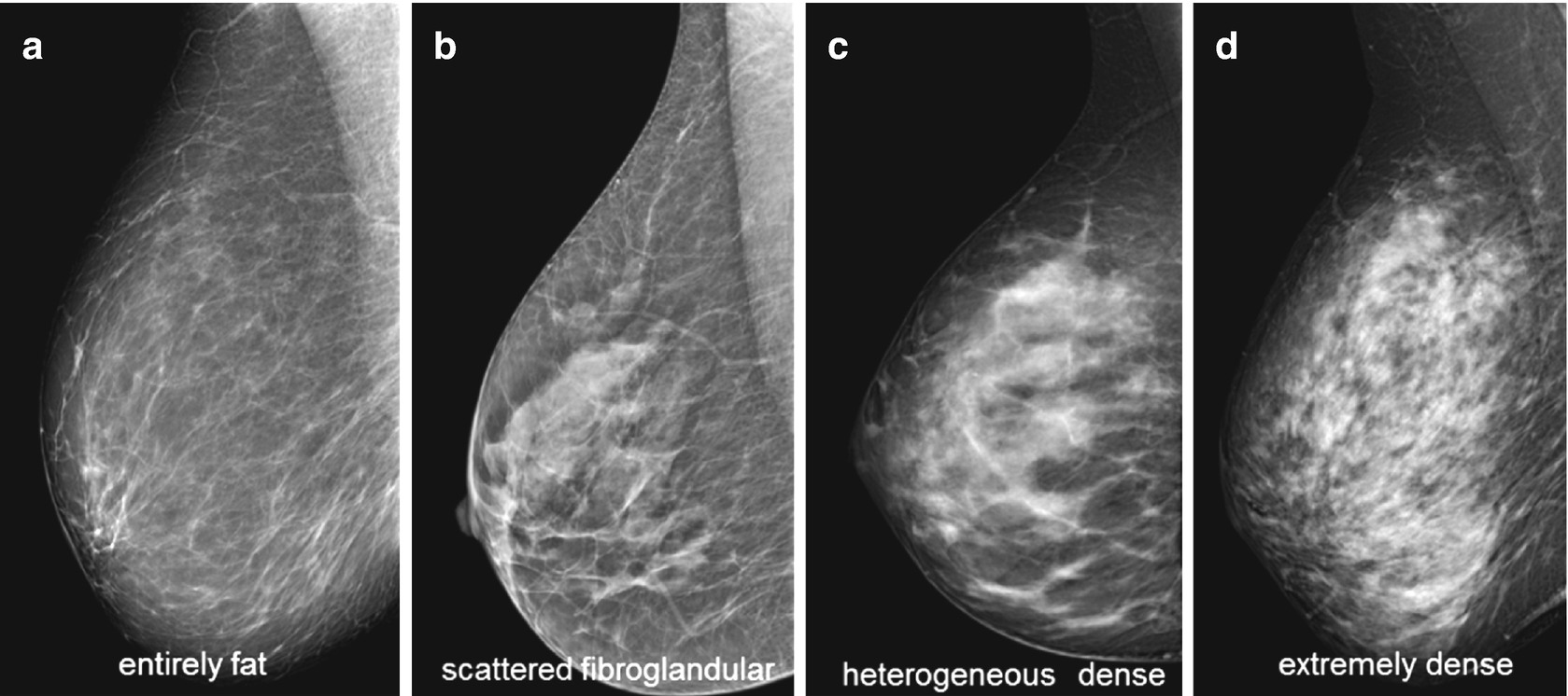 Mammographic Breast Density And Its Effects On Imaging Springerlink