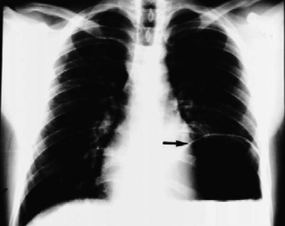 Surgical Management: Other Diaphragmatic Hernias in Adults | SpringerLink Surgical Management: Other Diaphragmatic Hernias in Adults | SpringerLink