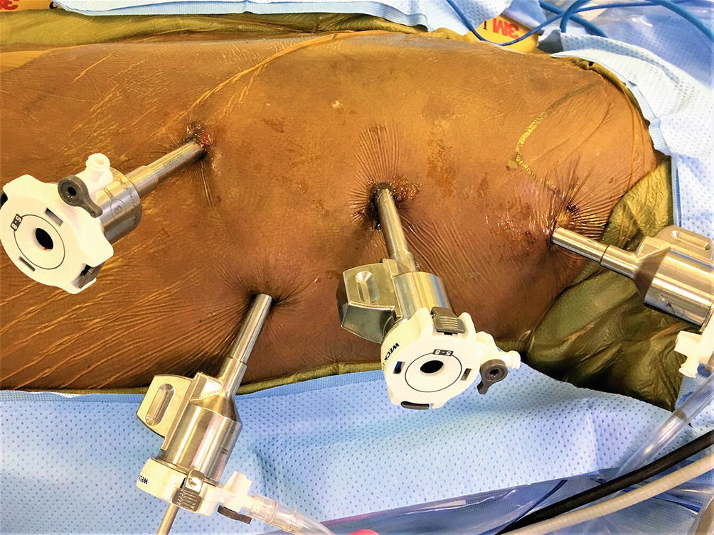 Robotic Esophagectomy Springerlink