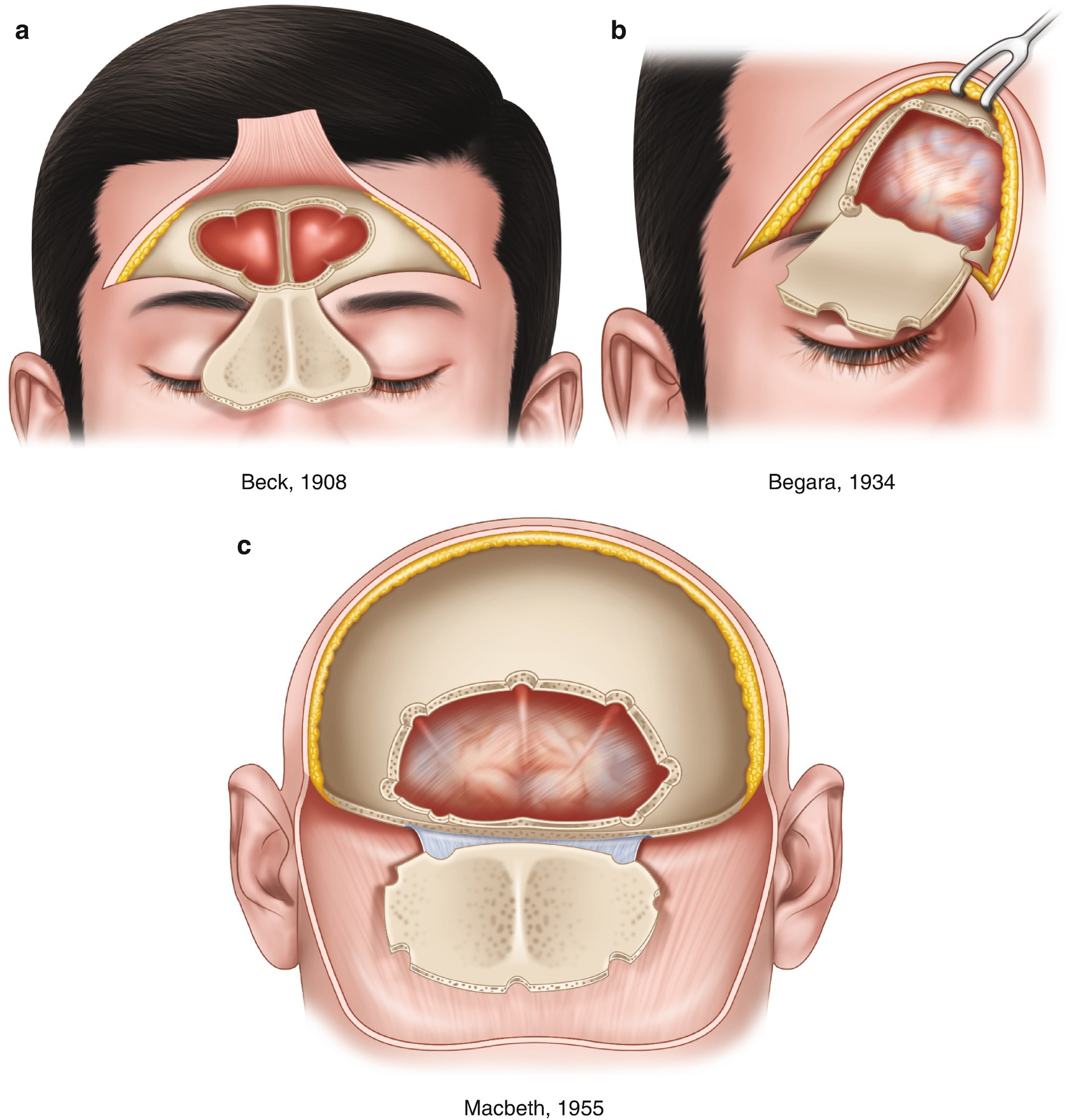 Evolution And Challenges In Frontal Sinus Surgery Springerlink