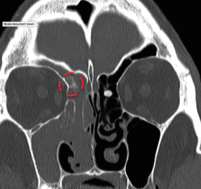 Intraductalis sinus papilloma