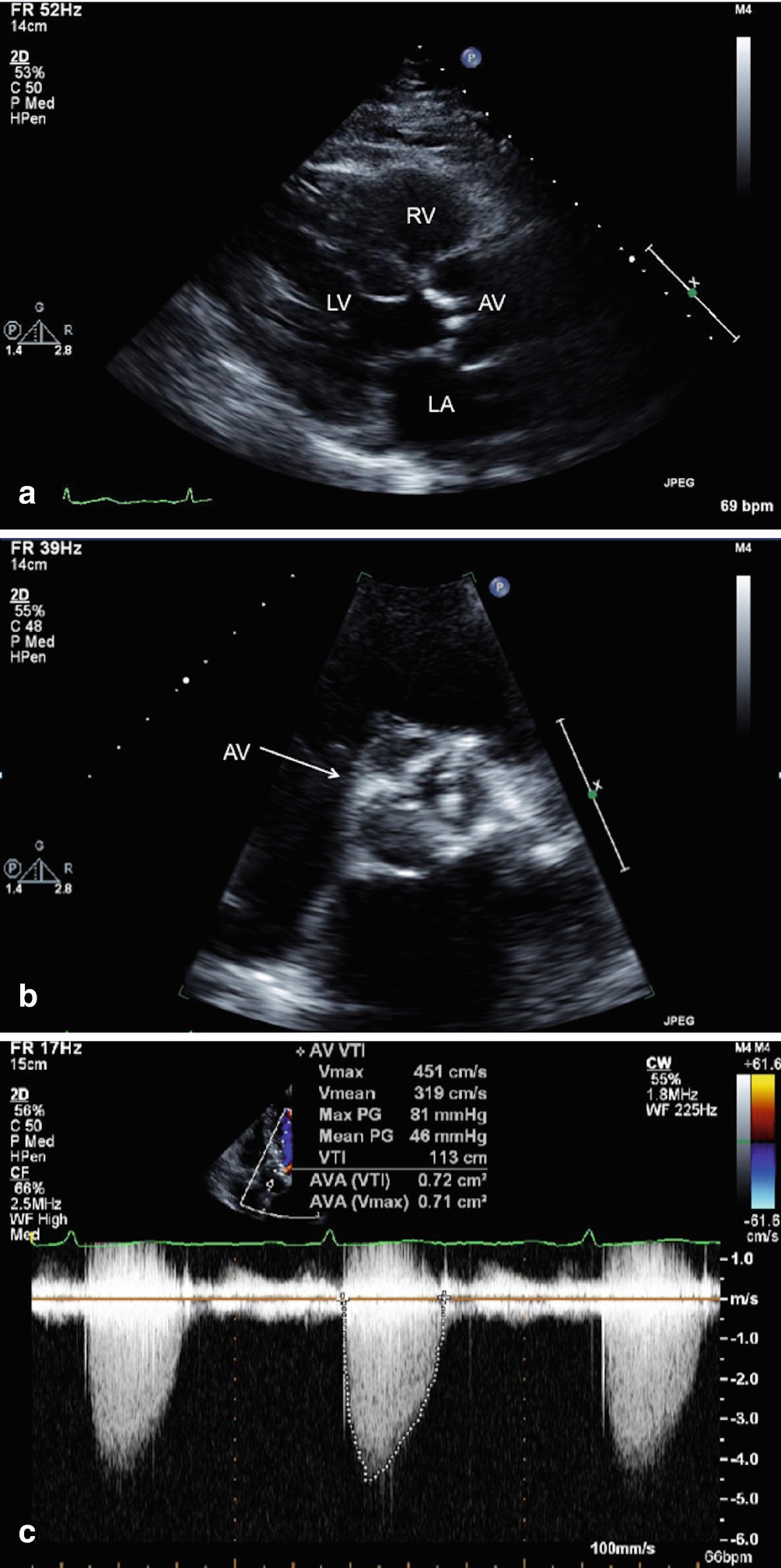 Valvular Heart Disease Springerlink