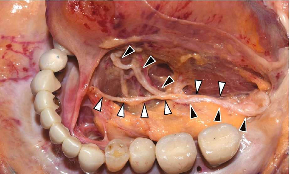 Anatomy And Variations Of The Sublingual Space Springerlink