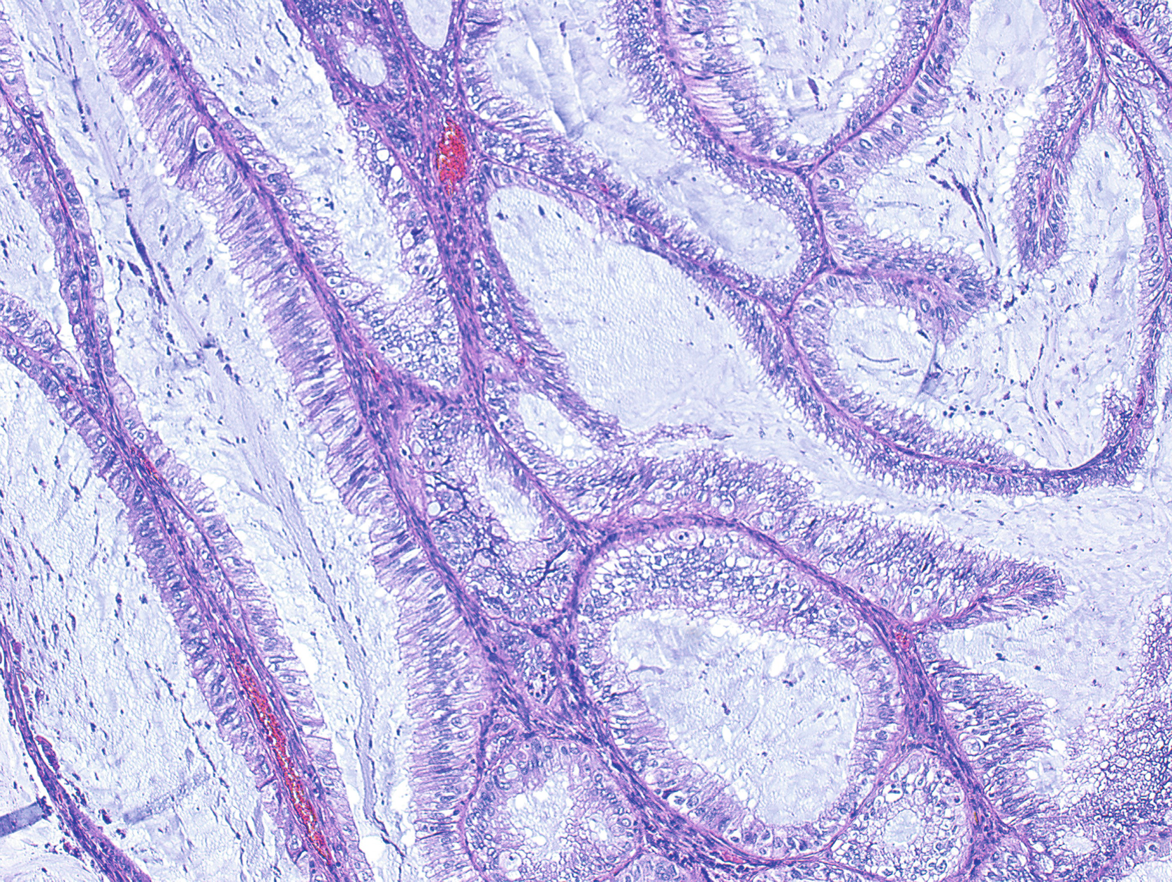 Endometrial Carcinoma Springerlink Endometrial Carcinoma Springerlink