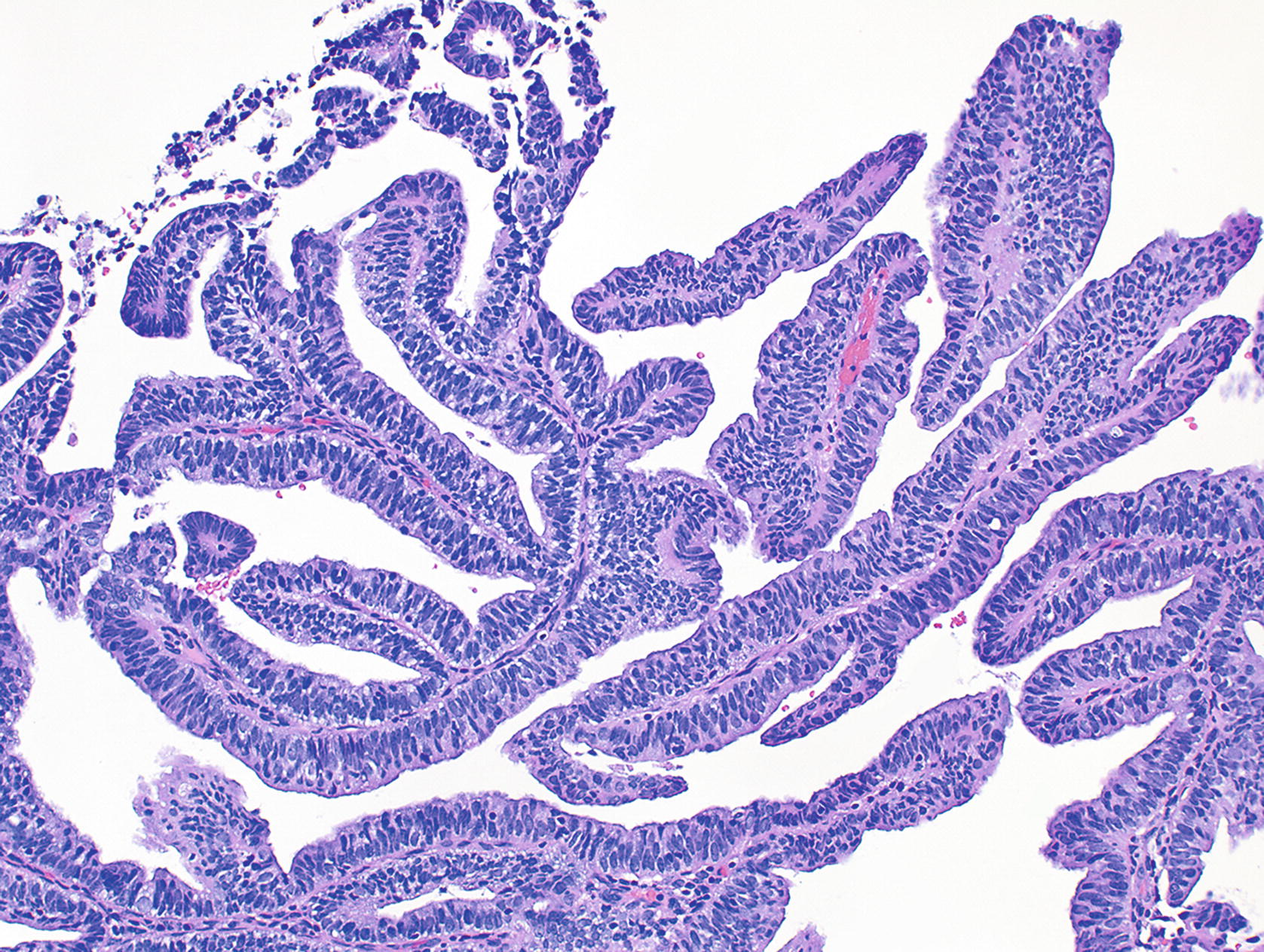Endometrial Carcinoma Springerlink Endometrial Carcinoma Springerlink