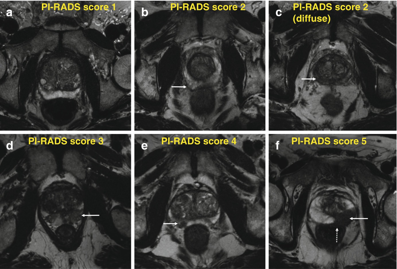 Our initial experiences with mpMRI-ultrasound fusion-guided prostate biopsy
