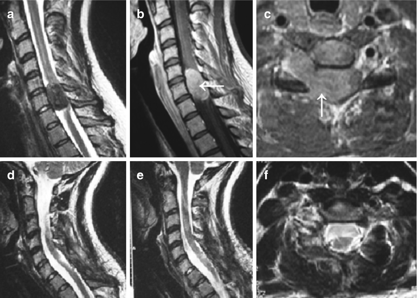 Dumbbell Tumors of the Spine | SpringerLink