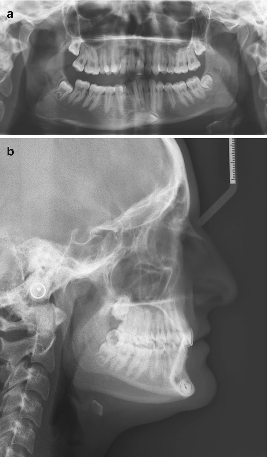 Conventional Radiographic Findings In Tmj Disorders Springerlink