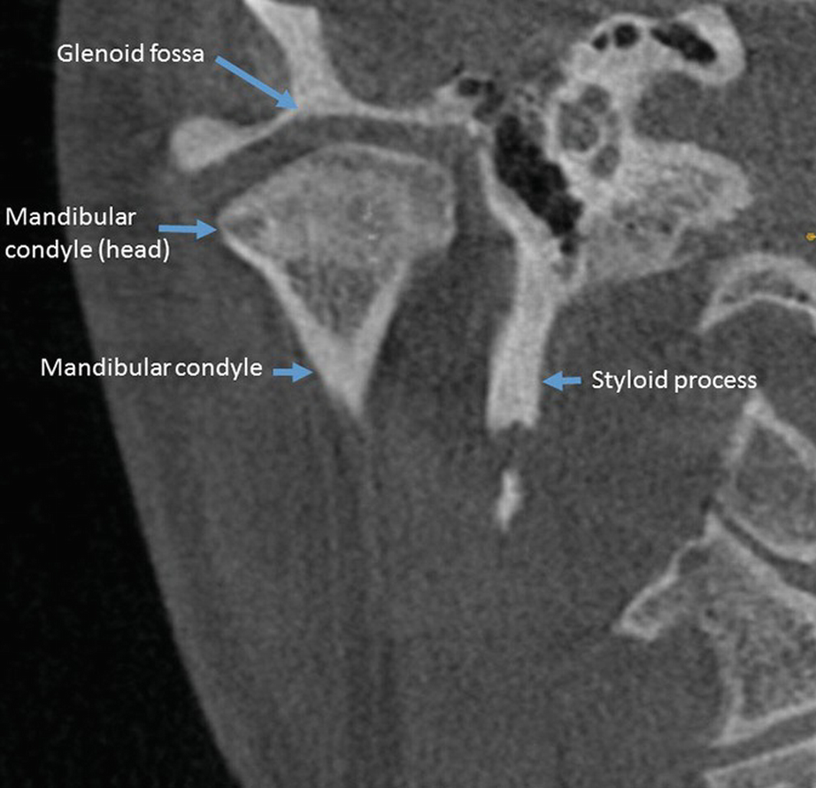 Image result for tmj mri anatomy