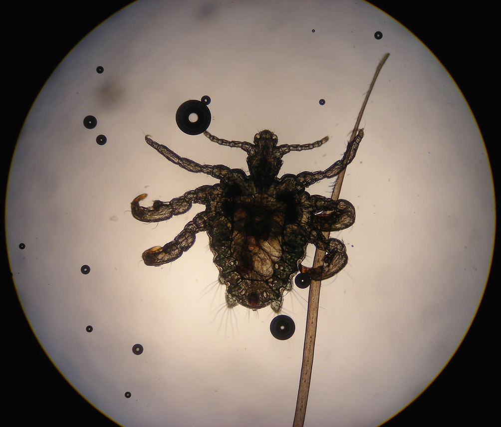 Pediculosis Pubis Springerlink