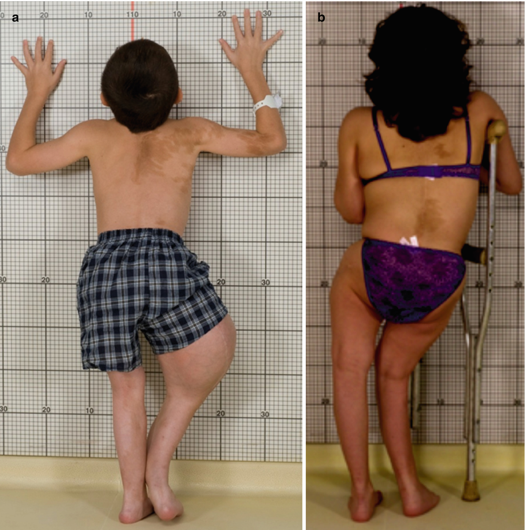 Mccune Albright Syndrome Springerlink