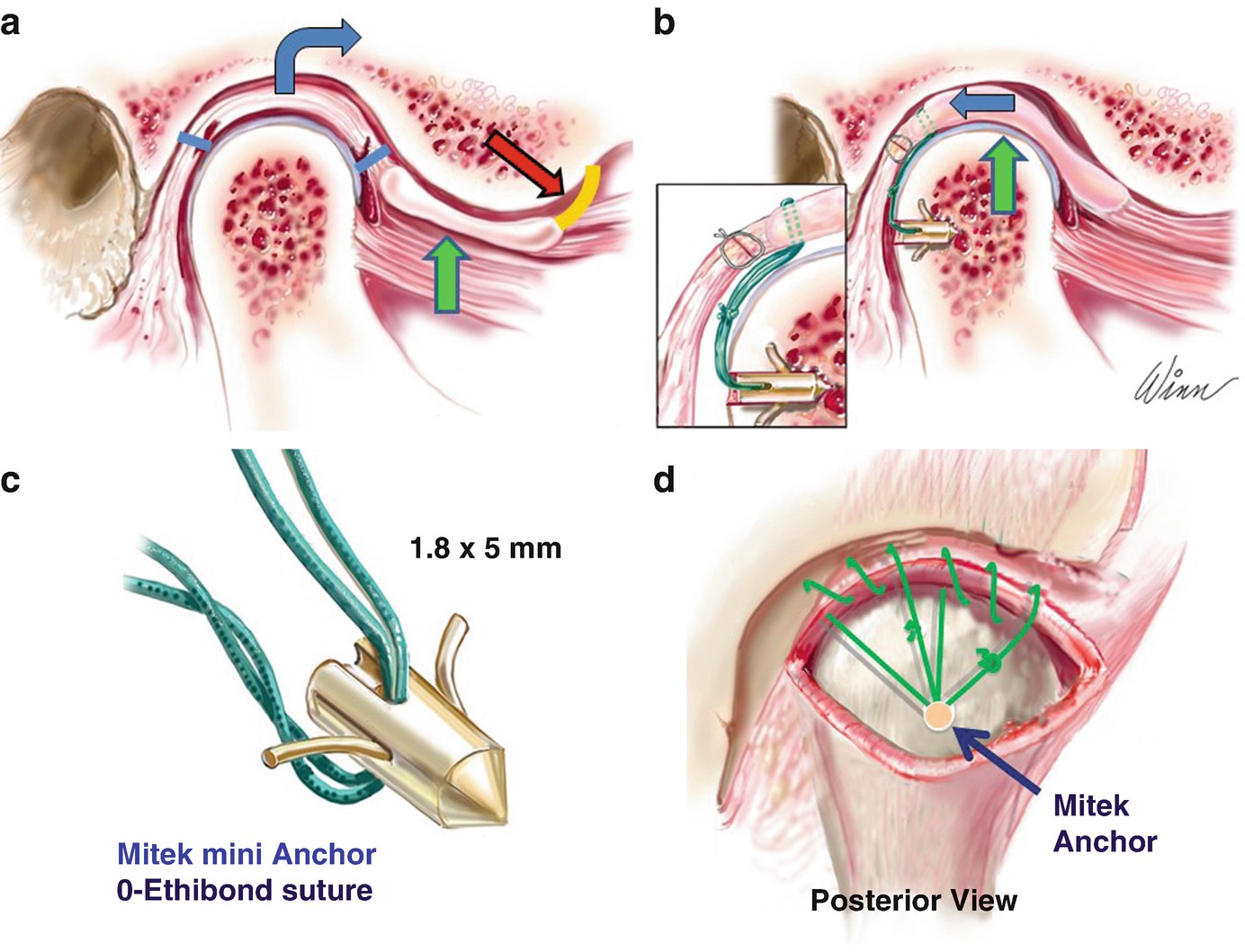 Surgery Of The Temporomandibular Joint Discectomy And