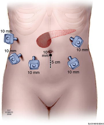 Cancer Of The Pancreas The Whipple Procedure Springerlink