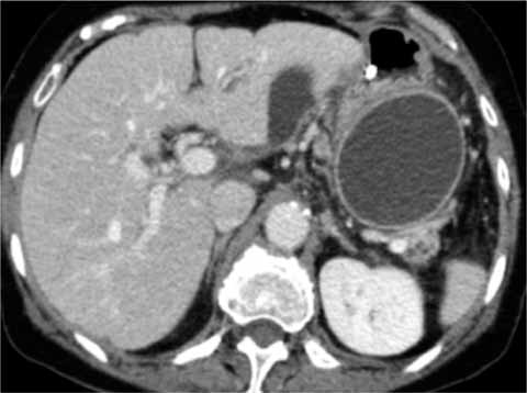Imaging Of Pancreatic Pseudocyst Springerlink