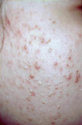 Clinical Aspects Of Acne Vulgaris Springerlink