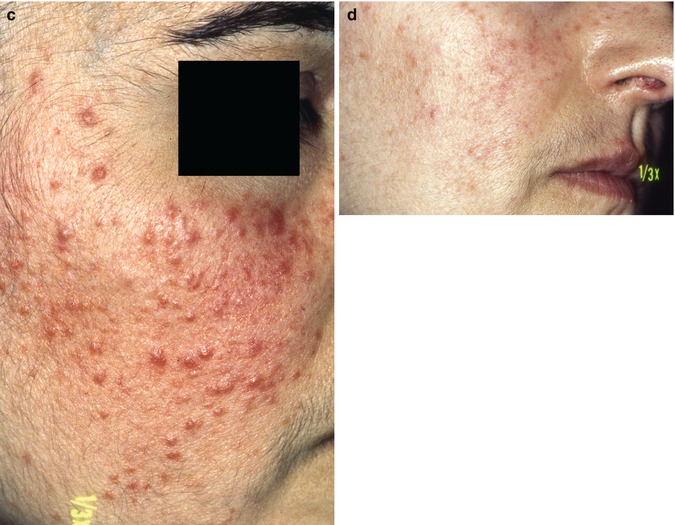 Azelaic Acid | SpringerLink
