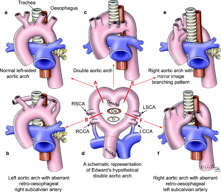 Aortic Vascular Rings Springerlink