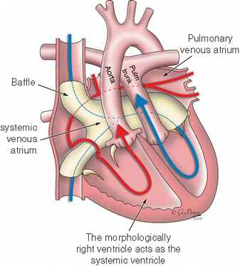 Transposition of the Great Arteries: Senning and Mustard Repair ...