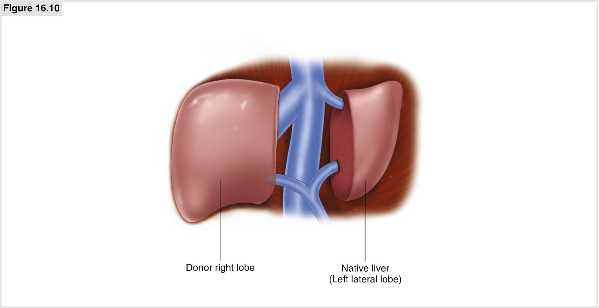 Auxiliary Liver Transplantation Springerlink