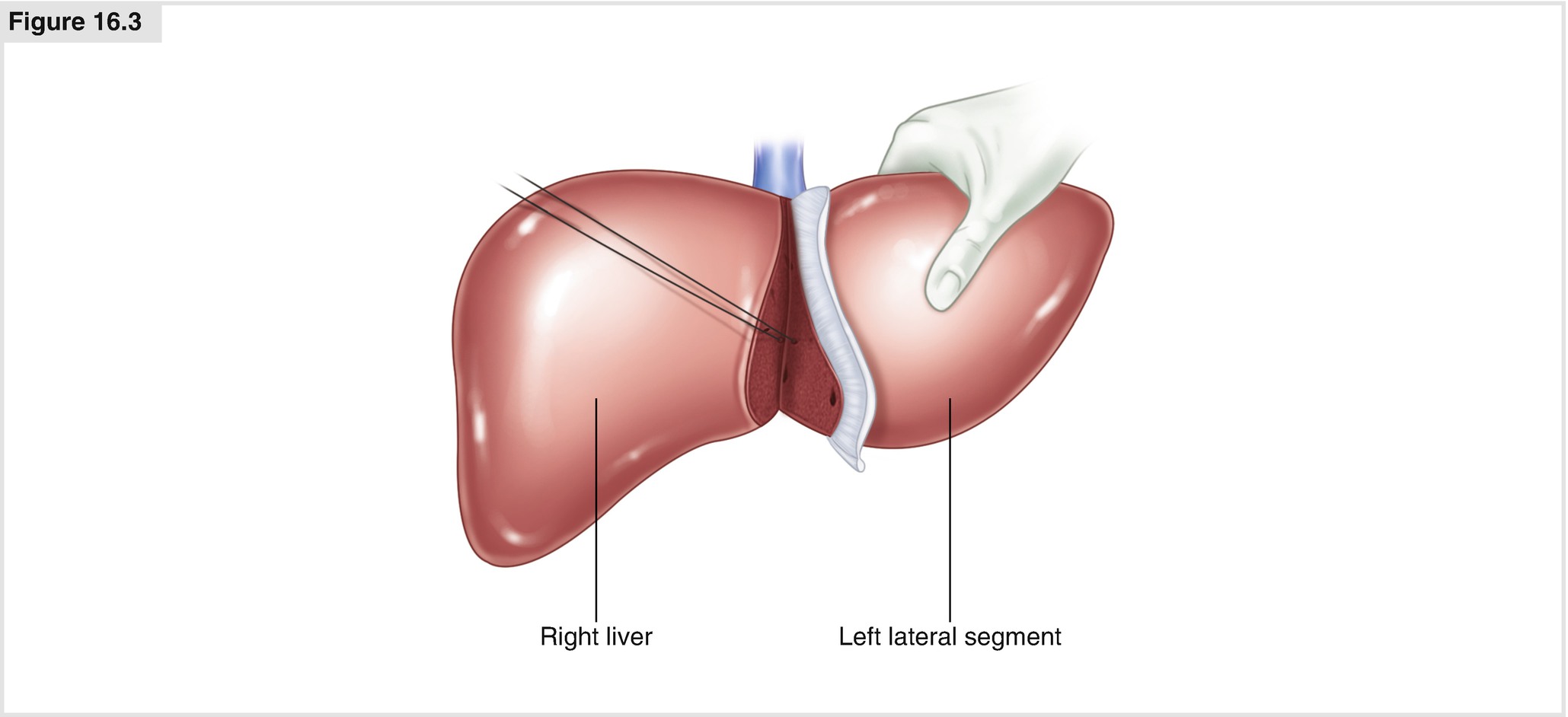 Auxiliary Liver Transplantation Springerlink
