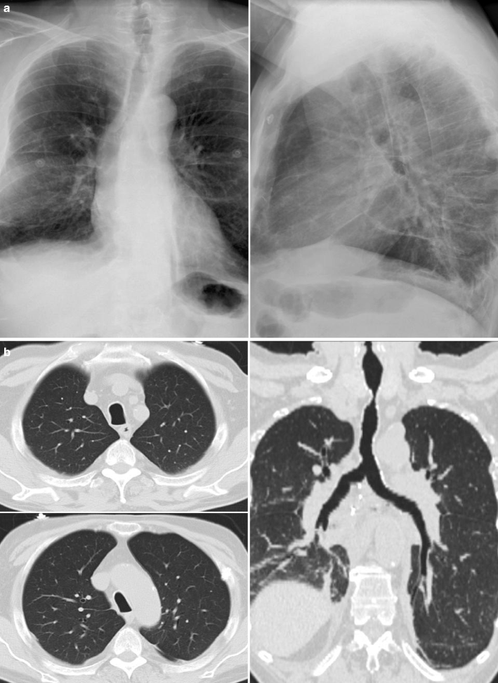 trachealis papilloma ct lehetséges a szemölcsök eltávolítása a cryopharm segítségével