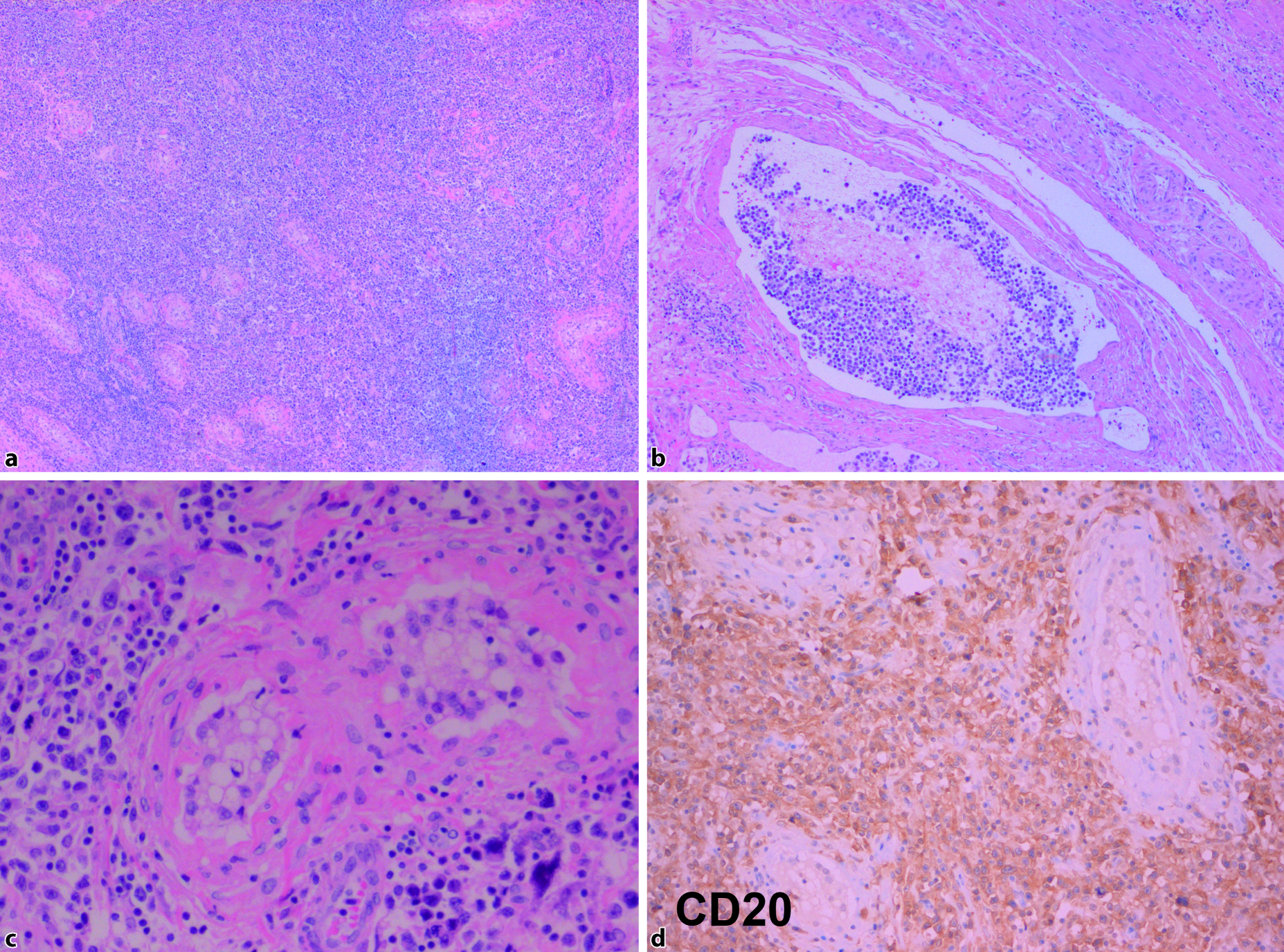 Lymphoproliferative Erkrankungen Des Weiblichen Und Mannlichen