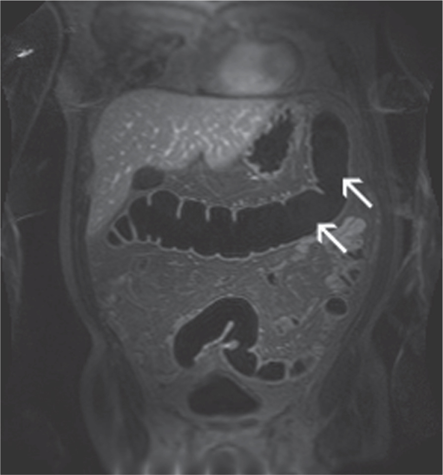 MRI of the Colon (MR Colonography) Technique SpringerLink