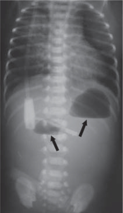 Duodenal Atresia Duodenal Stenosis Web Springerlink Duodenal Atresia Duodenal Stenosis Web Springerlink