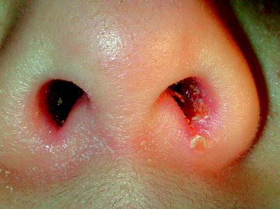 Nasal Vestibulitis And Nasal Furunculosis And Mucormycosis