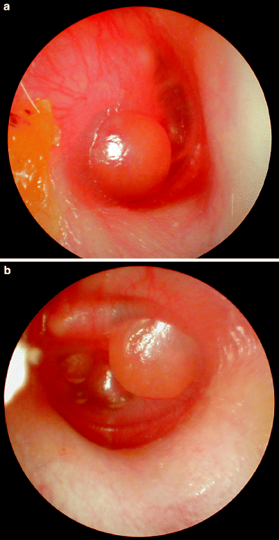 Acute Otitis Media Springerlink