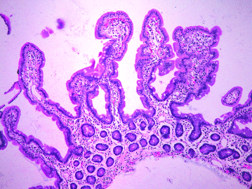 histologie duodenum giardiasis)