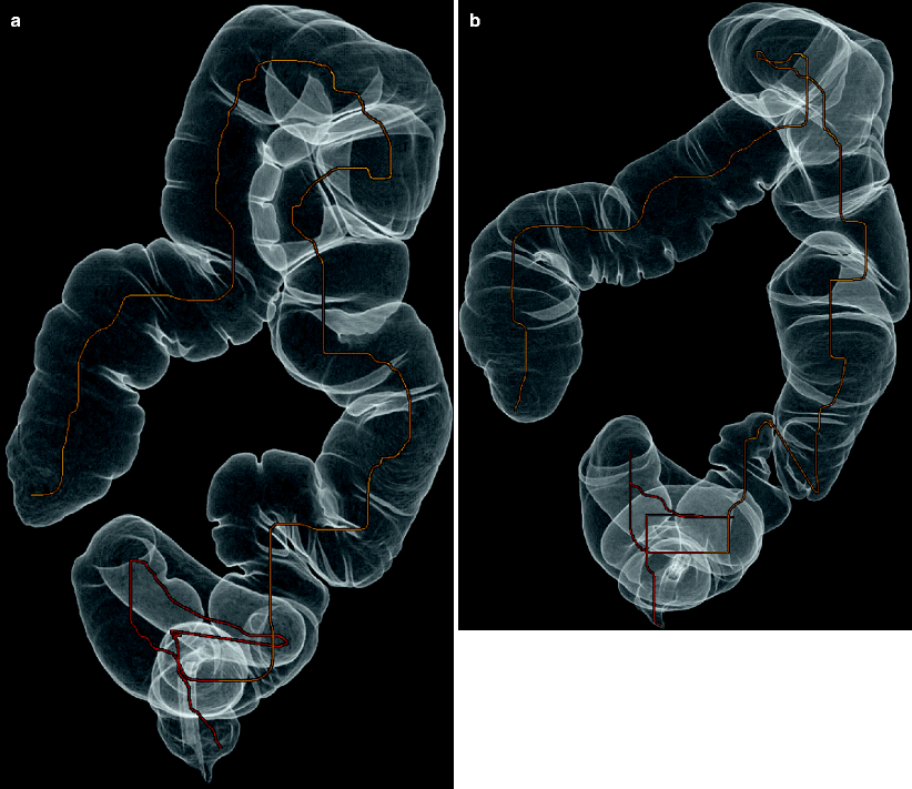 The Ileocecal Valve SpringerLink