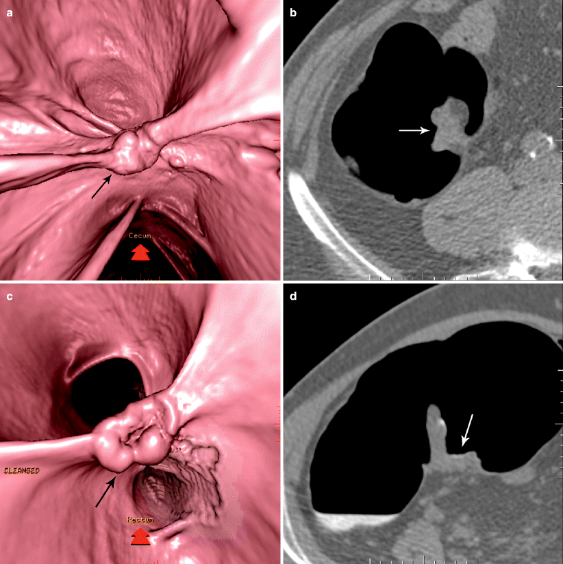 The Ileocecal Valve SpringerLink