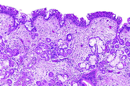 Pathology of Nasal Polyps | SpringerLink