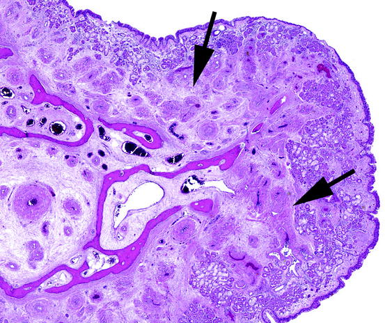 Pathology of Nasal Polyps | SpringerLink